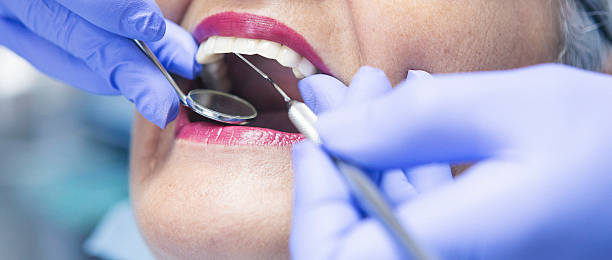 Teeth Whitening in GA